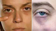 Tmavé kruhy pod očima? Odborníci uvádějí hlavní příčiny jejich vzniku a způsoby, jak je odstranit