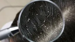 Zapomeňte na drahé šampony a chemii: Zbavte se lupů díky ingredienci, kterou máte doma