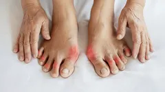 Neustále vás bolí klouby na prstech nohou? Odborníci vysvětlují, jak se bolesti navždy zbavit